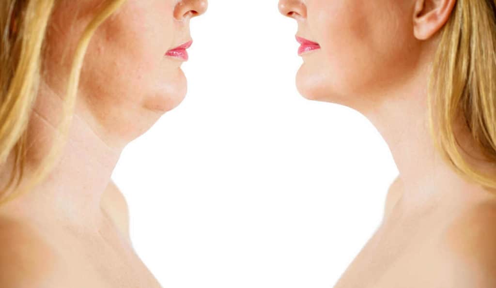 Double Chin treatment Witney before and after results