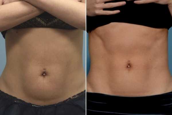 body sculpting FAQs Witney