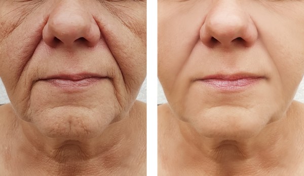Learn more about Morpheus8 Treatment Witney today!