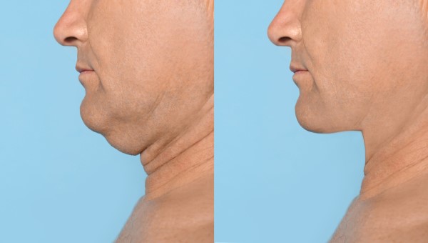 Which Non-Surgical Treatments Work Best for Jowls and Loose Skin Witney?