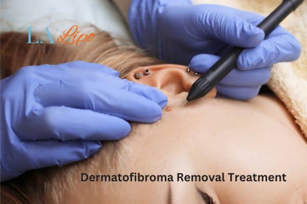 Dermatofibroma Removal Treatment Witney