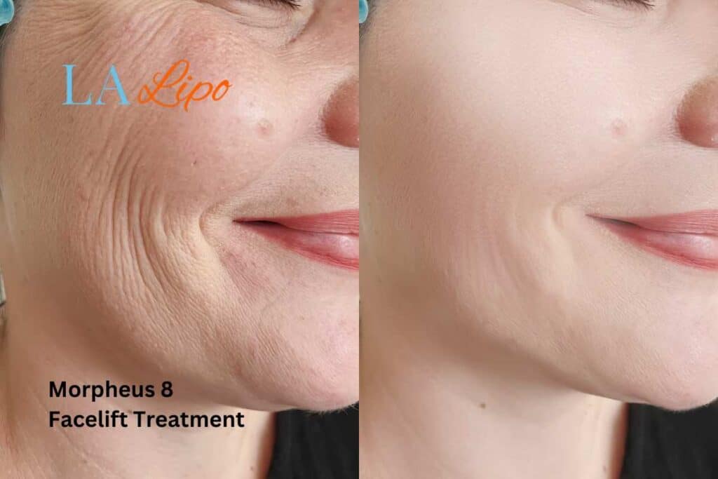 Morpheus8 Treatment Witney for flawless skin! Call us today!