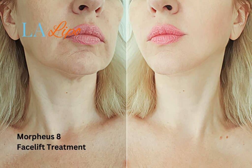 Turn back time with Morpheus8 Treatment Witney