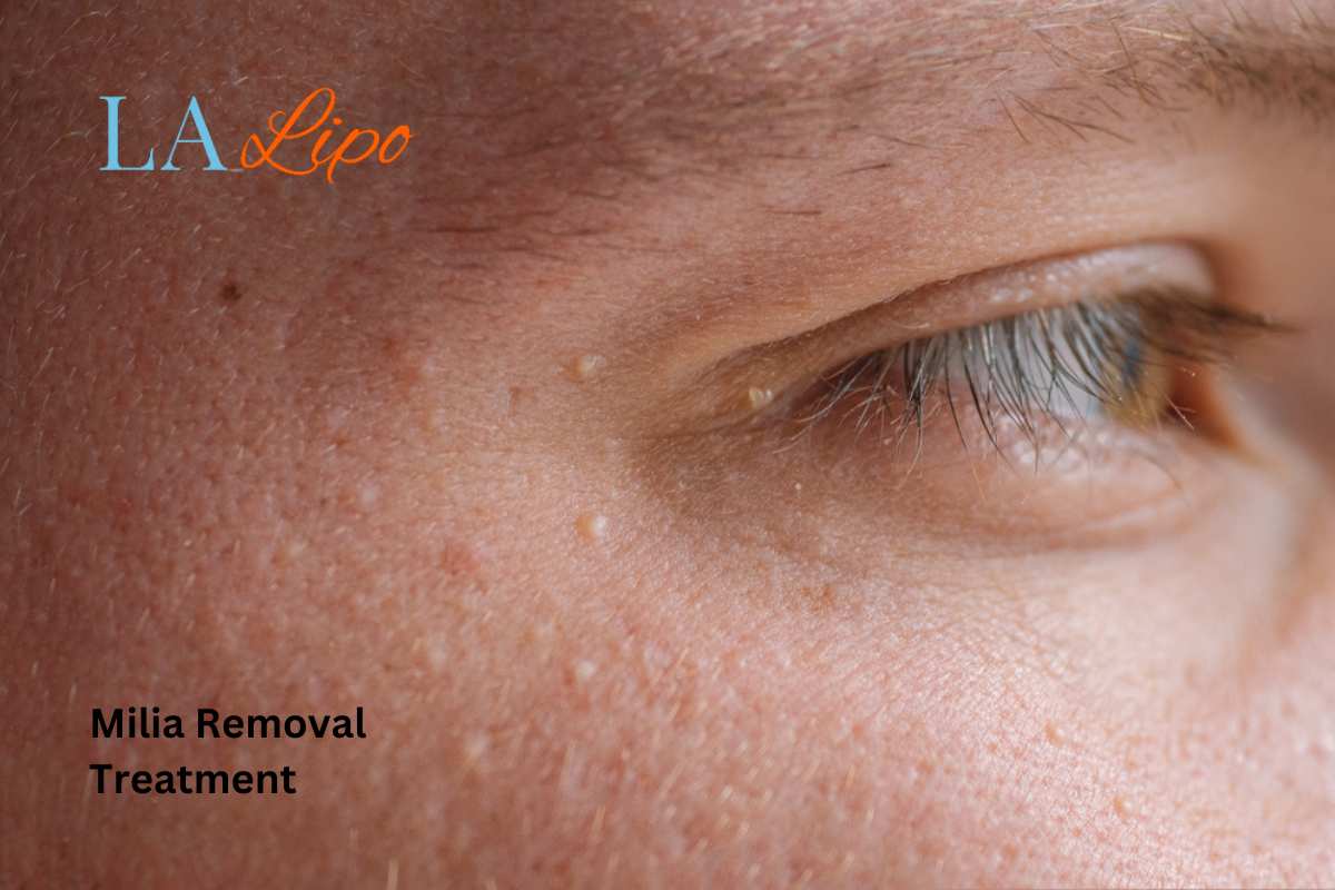 Cryopen Milia Removal: Is It the Easiest and Safest Option Witney?