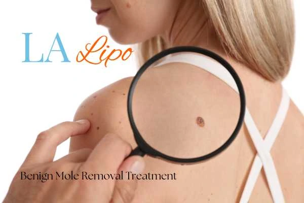 Why getting moles removed Witney can boost your confidence!