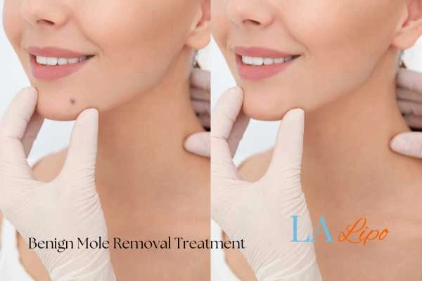 woman's before and after mole removal Witney results