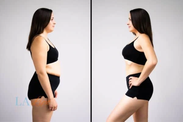 image of woman before and after results of LA-EMS Body Sculpting Witney to help treat Diastasis recti