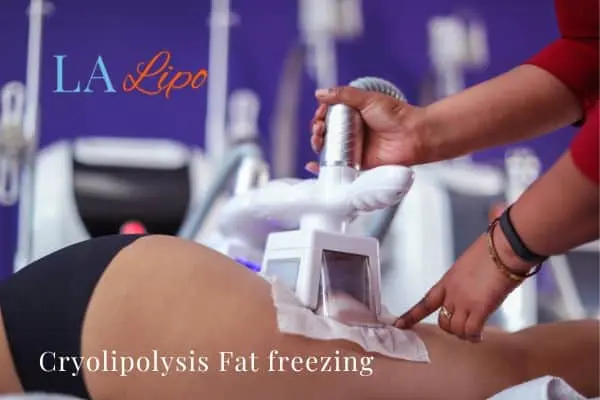 women getting fat freezing Witney