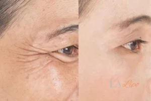 Before and after results of woman - HI-fu wrinkles reduction treatment Witney