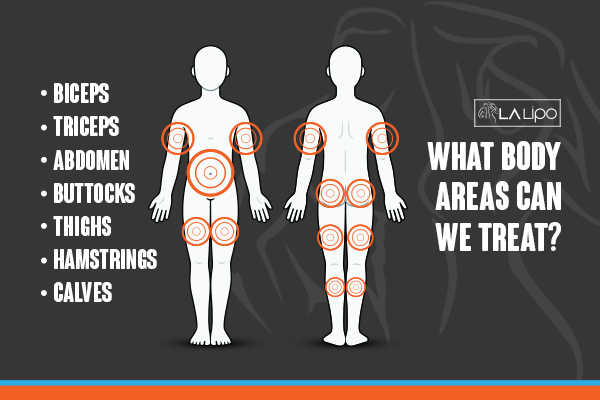 Graphic to show areas you can have LA-EMS Body Sculpting Witney treatment.