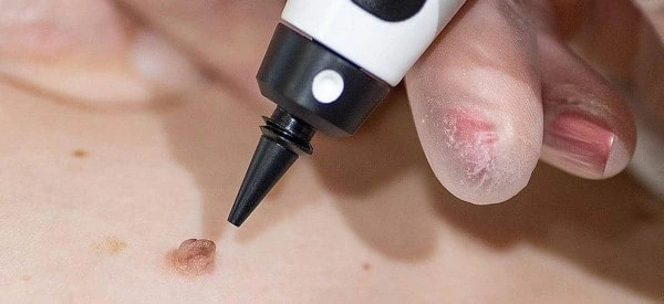 skin tag removal using cryopen Witney