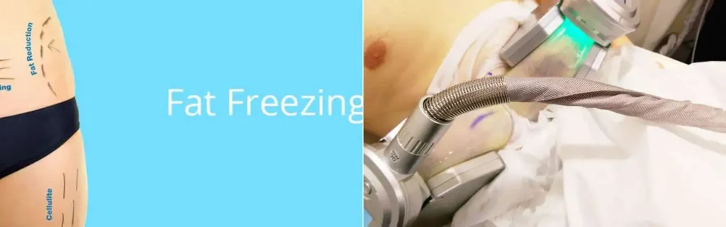 Fat freezing Witney on multiple areas of the body