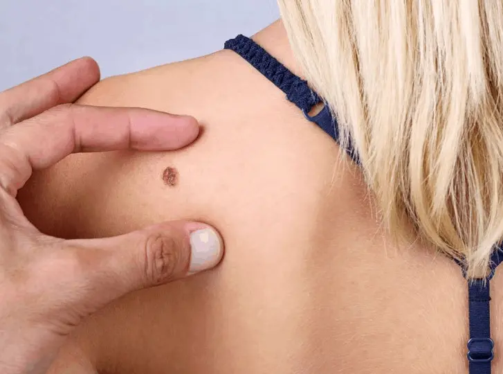 woman having mole removal Witney consultation before treatment.