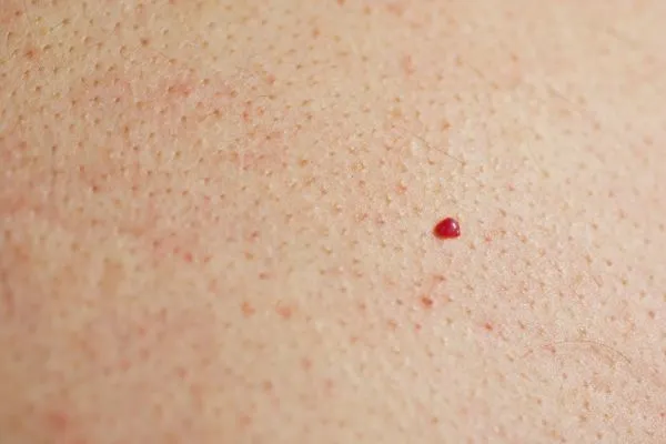 close up of a cherry angioma Witney