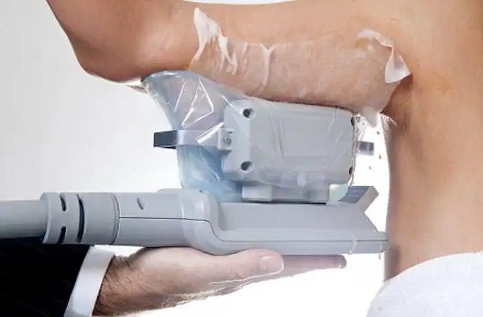 Picture of fat freezing Witney on the upper arms.