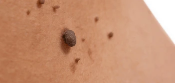 image of a skin tag Witney