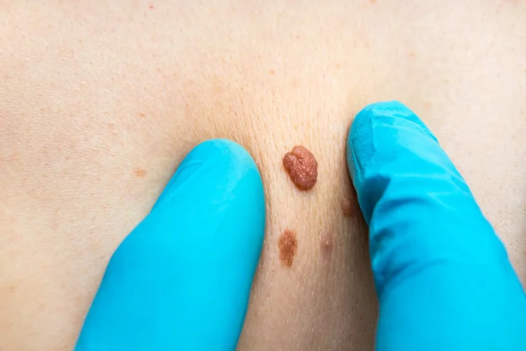 Consultant examining a skin tag Witney