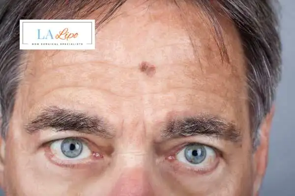 Solar Lentigo Removal Witney image of man with mark on his forehead