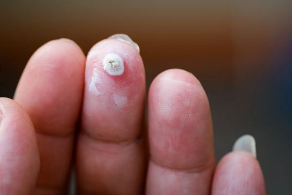 wart on person finger - cryotherapy to treat from LA LIPO Witney