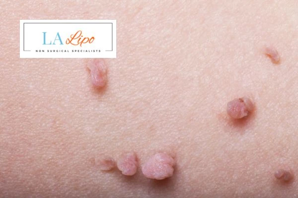 Does cryopen skin tag removal Witney hurt? Find out now call our team today!