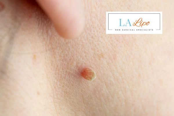 Book skin tag removal Witney today speak to our team now!