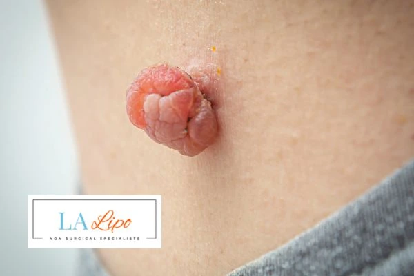 Interested in skin tag removal Witney? Concerned about the pain? Find out more today!
