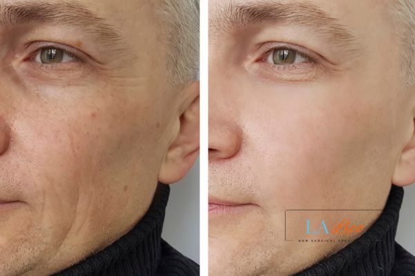 See the amazing results of Morpheus8 Treatment Witney!