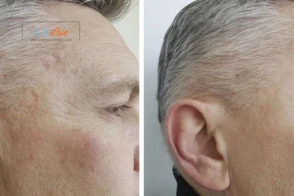 Mens Before & After Morpheus 8 Results Witney