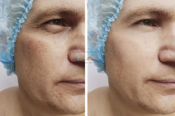 Before and after Morpheus 8 Results Witney