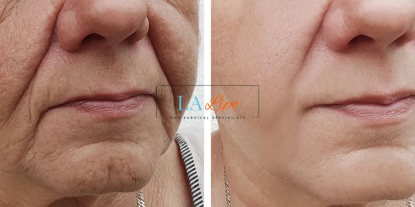 Older lady deeper wrinkle reduction - LA LIPO Morpheus 8 Results Witney