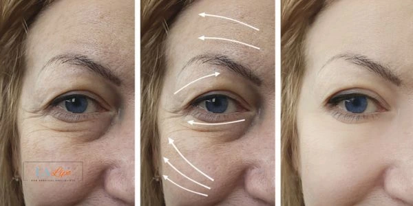 Amazing eye lift Morpheus 8 results Witney