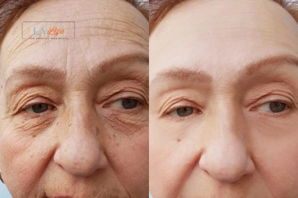 The powerful benefits of Morpheus8 Treatment Witney - Call Our team today!