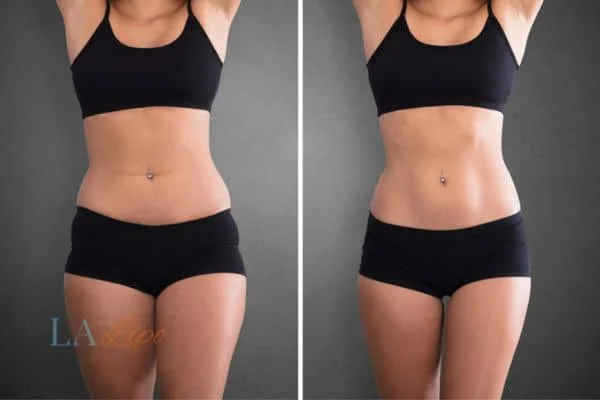 before and after results of non-surgical treatment to help a woman's body image and mental health Witney