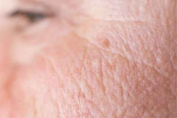close up picture of a woman's face showing an age spot Witney