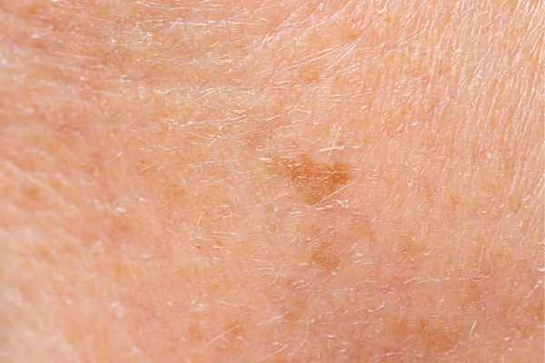close up picture of age spots Witney