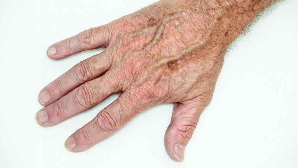 Male hand showing age spot Witney