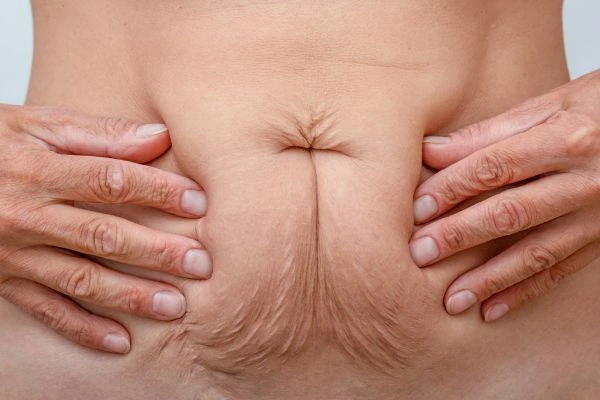 Image of a woman's stomach with loose skin - example of skin tightening Witney options