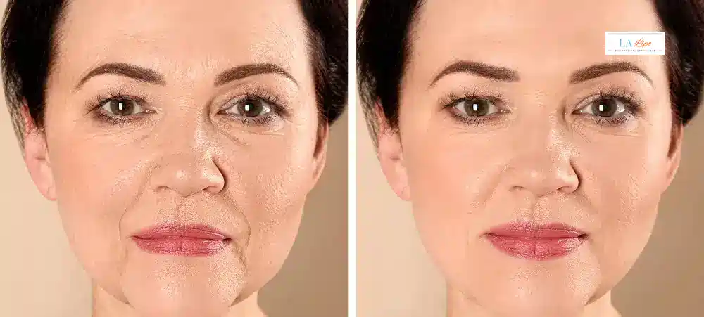 How Long Does It Take to See Results and How Long Do They Last Witney?