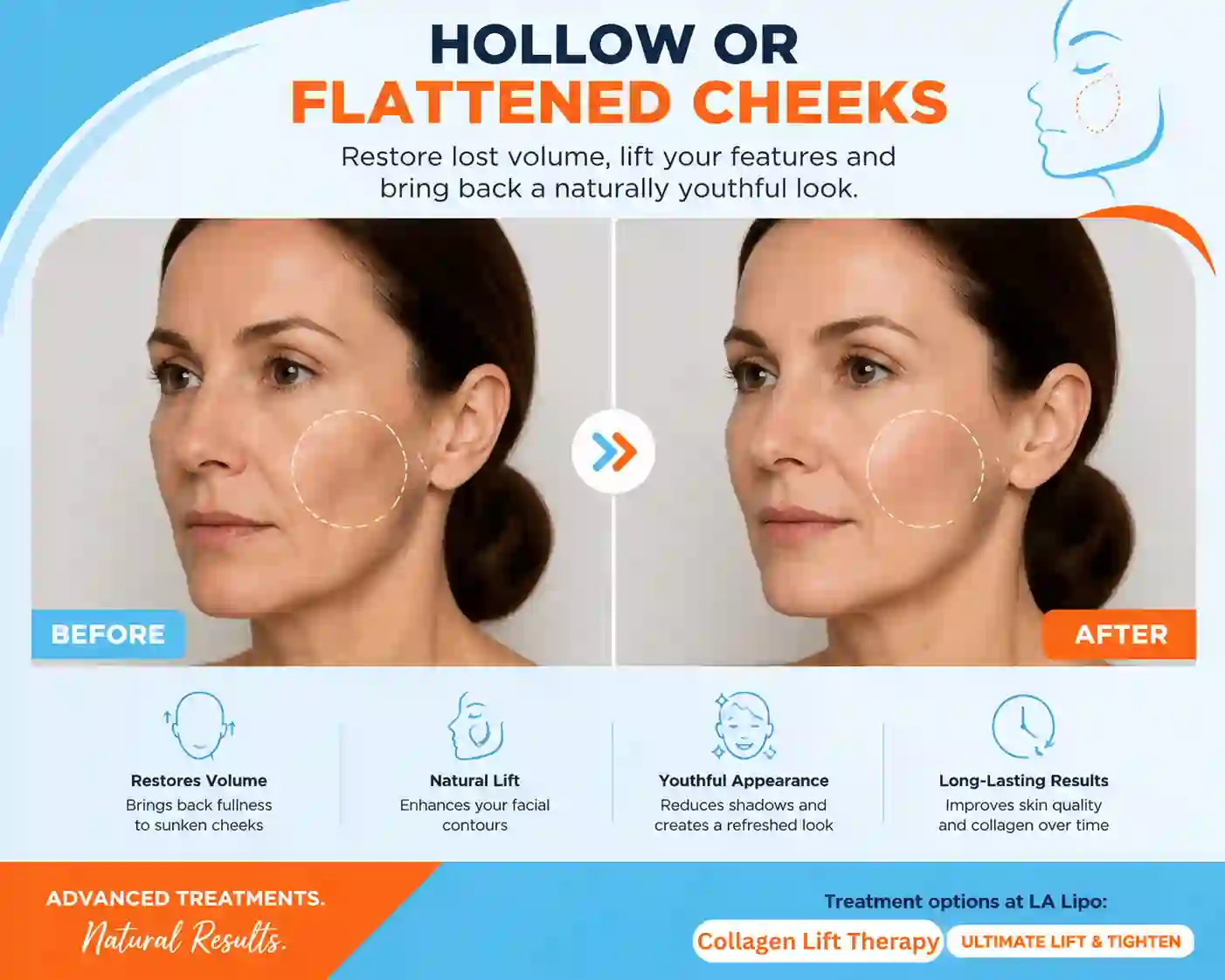 Sign #4: Hollow or Flattened Cheeks Witney